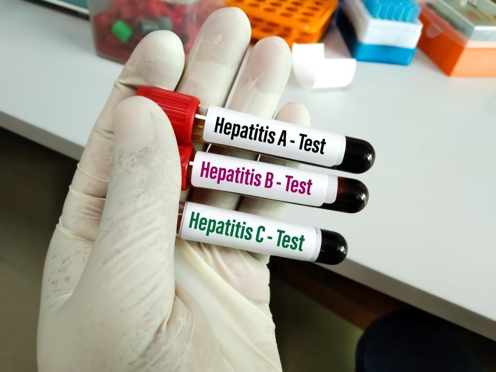 how to diagnose hepatitis.
