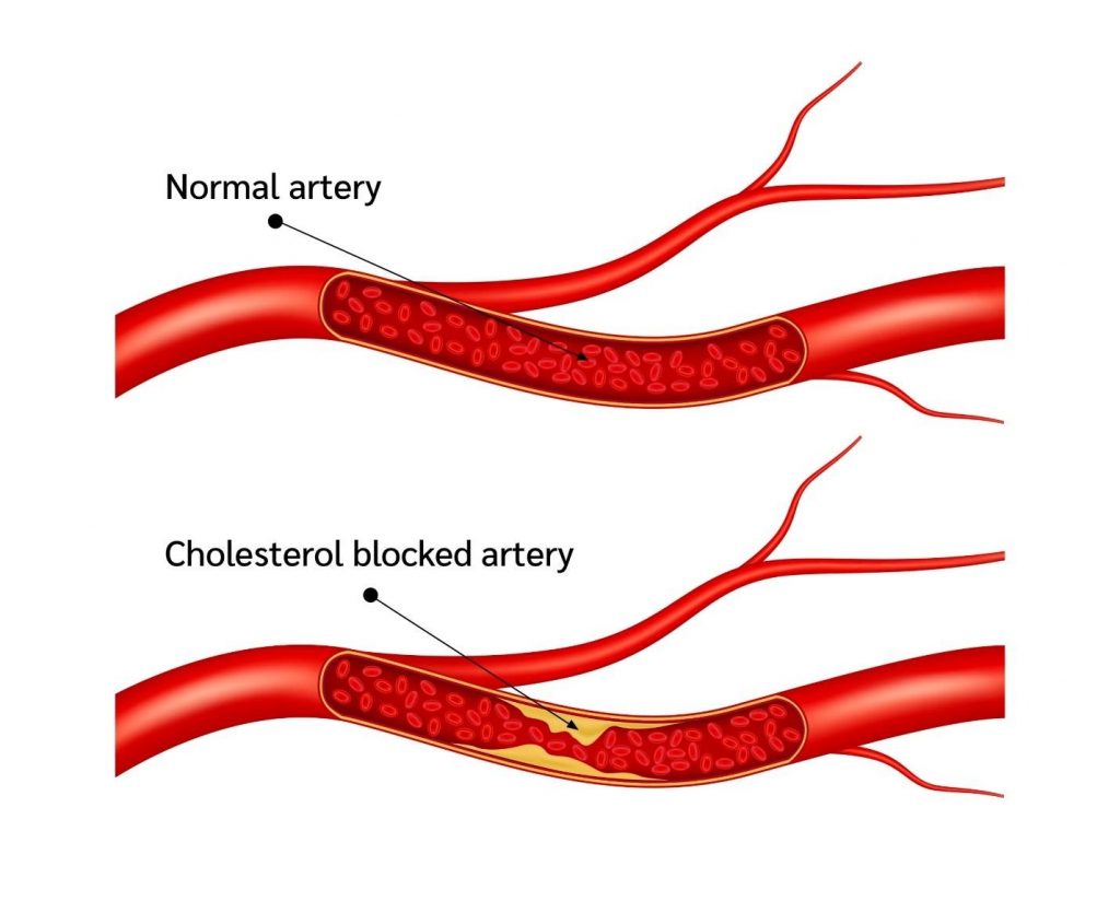 complications of high cholesterol.