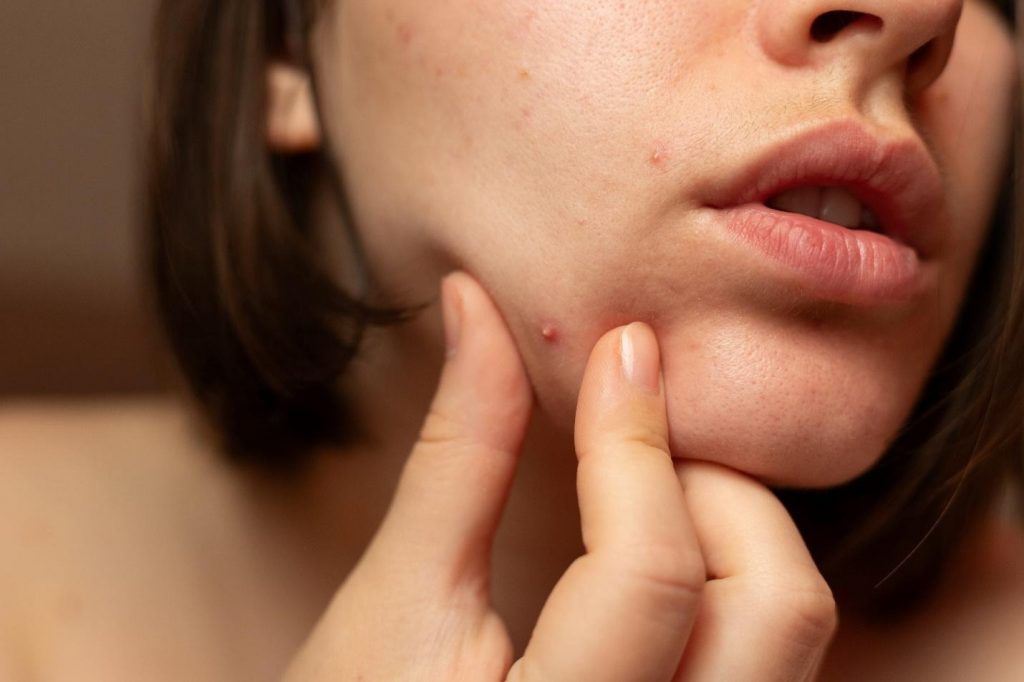 what is the impact of acne.