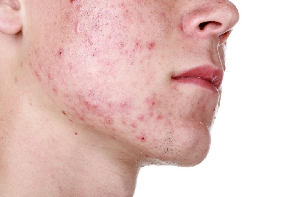 how to manage acne.