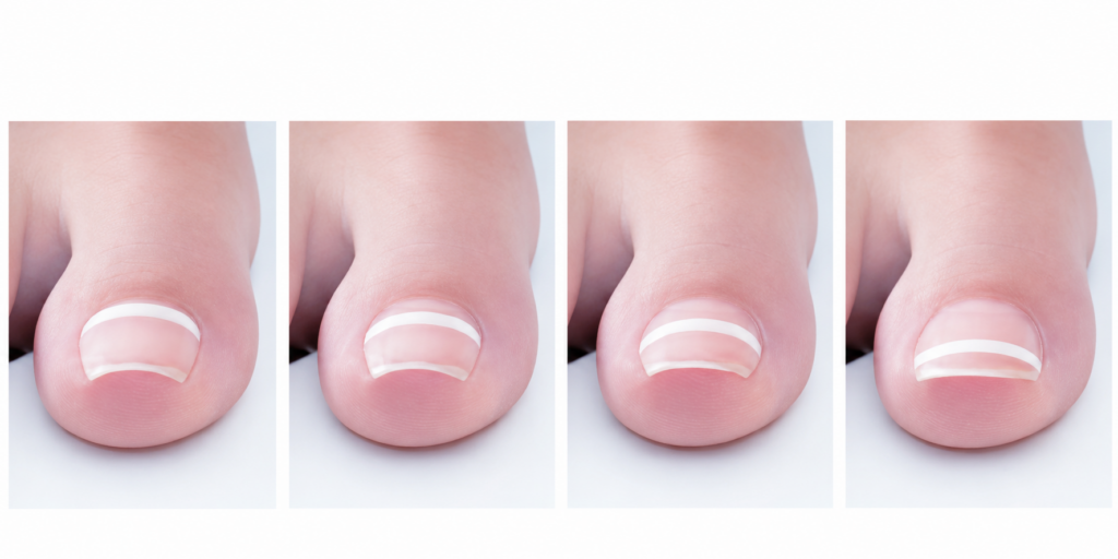 Onyfix toenail treatment Singapore.