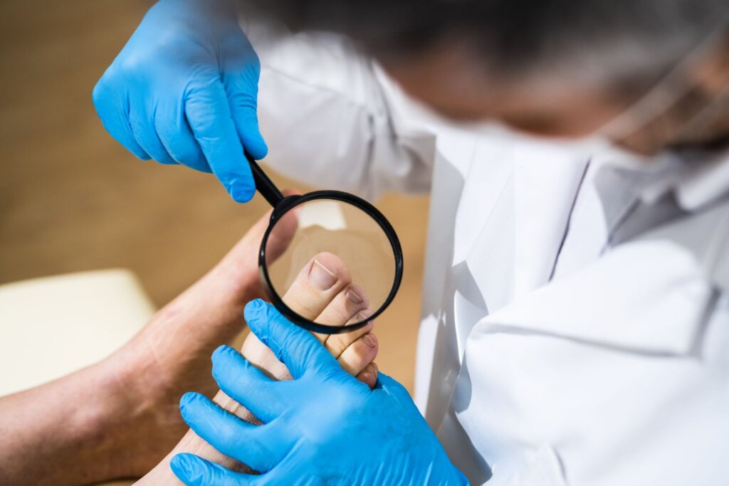 ingrown toenail treatment onyfix podiatry Singapore.