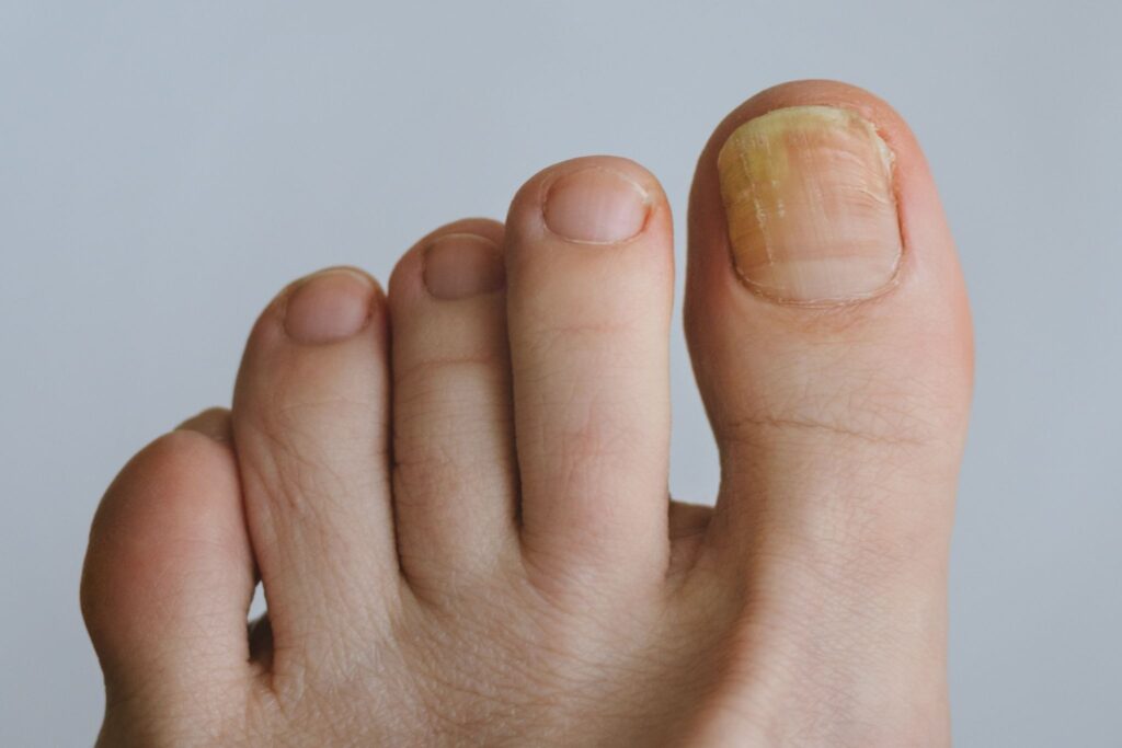fungal toenail infection lunula laser treatment Singapore.