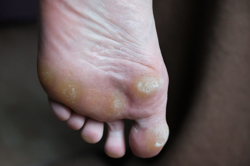 corn and callus treatment podiatry singapore.